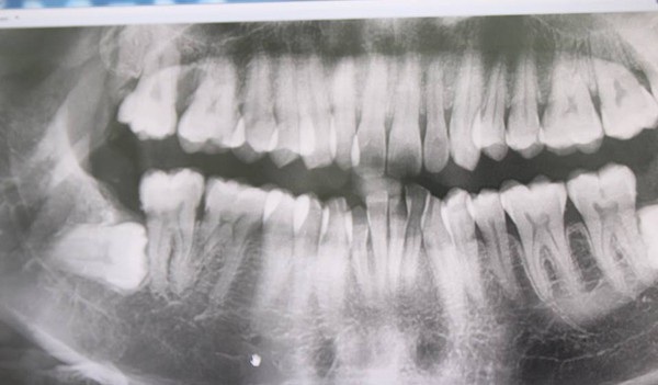 Răng khôn đâm thủng má, cô gái trẻ phải bỏ thai - 1