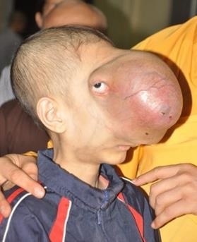 Hành trình 8 năm tìm lại cuộc đời của cậu bé 'không có mặt' - 1 Sau 4 năm, khối u ác tính đã phá hủy một phần xương sọ, xoang trán, ăn sâu vào nền sọ, đe dọa nghiêm trọng đến tính mạng