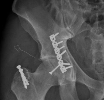 Phẫu thuật thành công cho phi công Canada gãy trật khớp háng nặng - 1 Các bác sĩ Vinmec đã mổ nắn trật khớp, đồng thời kết xương bằng nẹp vít ổ cối để xử trí tai nạn trật khớp háng cho anh Dustin.