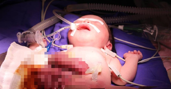 Bé gái vừa chào đời lộ nội tạng ra ngoài - 1
Toàn bộ ruột non, đại trạng của bé gái bị thoát ra ngoài thành bụng qua lỗ rốn