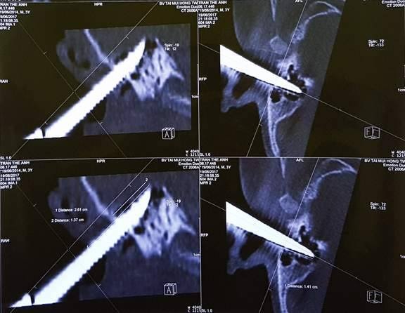 Hãi hùng cảnh bé trai 2 tuổi bị kéo đâm sâu vào tai - 2 Hãi hùng cảnh bé trai 2 tuổi bị kéo đâm sâu vào tai - 2