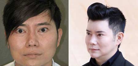 Nâng mũi làm đẹp và những hệ lụy - 2
Biến chứng lõm đầu mũi sau phẫu thuật thẩm mỹ