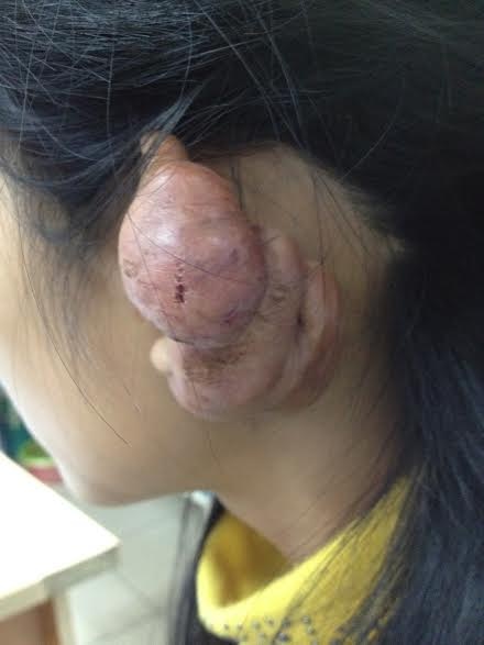 Kinh hoàng nổi u, phù tai sau khi bấm lỗ tai - 2 Ảnh minh họa.