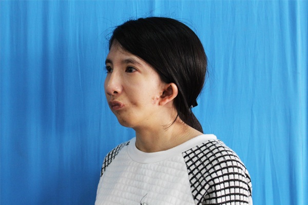 Phẫu thuật dị tật hàm mặt thành công cho cô sinh viên đa tài - 1 Thương luôn ước mơ có một khuôn mặt lành lặn, xinh xắn như bao bạn nhỏ khác.