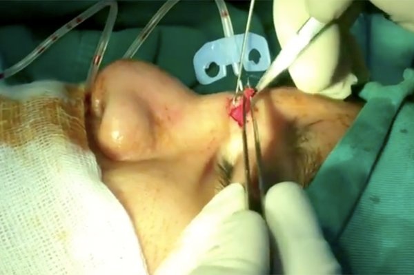 Miếng gạc được kéo ra từ mũi bệnh nhân