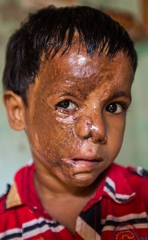 Không cưới được mẹ, trả thù man rợ bằng cách đổ axit lên mặt con - 1 Một nửa gương mặt của cậu bé bị tàn phá nặng nề