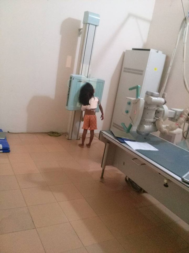 Vụ cổng trường đè gãy xương học sinh: Hiệu trưởng phải kiểm điểm trách nhiệm - 1 Bé P.T.K.H. gãy xương quai xanh, sưng trợt đầu gối vì bị cửa sắt cổng trường đổ đè vào người.