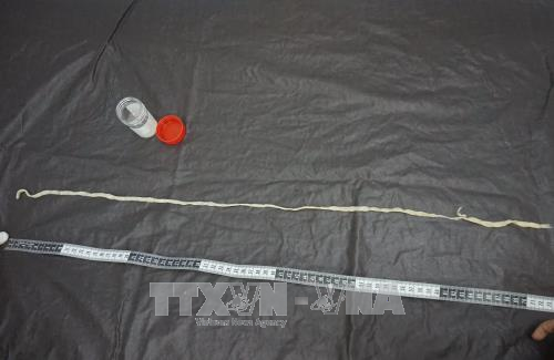 Nội soi gắp thành công sán xơ mít dài 1,2 mét - 2 Con sán xơ mít dài 1,2 mét được bác sĩ gắp ra ngoài cho bệnh nhân.