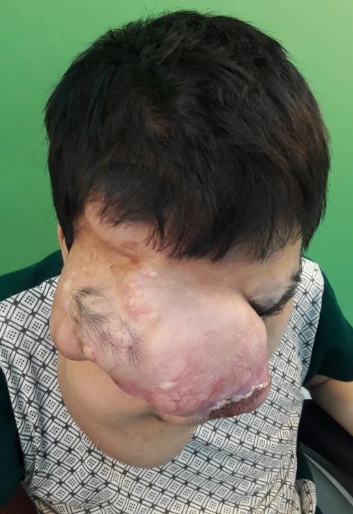16 tiếng bóc khối u ‘khủng’ trên gương mặt - 1 Hơn 1 năm trời, khối u của Thắng lớn nhanh và che lấp gần hết khuôn mặt