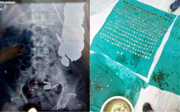 Kinh dị bệnh nhân nuốt 7kg tiền xu, đinh ốc vào bụng vì bị trầm cảm - 1 Bác sĩ gắp ra 263 đồng xu từ dạ dày bệnh nhân