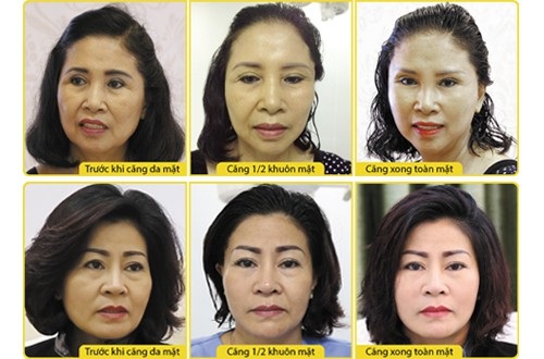 Bật mí phương pháp thách thức lão hóa, chinh phục phái đẹp trong nước và quốc tế - 1 Sợi chỉ không tiêu Hoa Kỳ bền chắc cho khả năng xóa nhăn, căng da như ý muốn