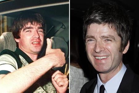 Loạt sao lớn “lột xác” nhờ sửa răng - 10 Do quá khứ nghiện ngập nên hàm răng Noel Gallagher từng bị xỉn màu và thậm chí còn có dấu hiệu bị… rơi rụng khiến cho nam ca sĩ hết sức hoảng sợ và quyết tâm cai nghiện vì một hàm răng chắc khỏe hơn