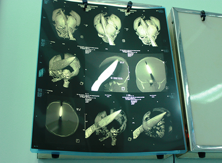 Hình chụp CT scan con dao đâm xuyên trán bé Phát ngày 8/8/2015