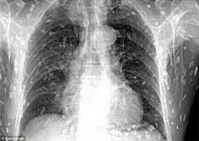 Chỗ nào cũng ngứa, vào viện mới biết con vật này len lỏi khắp cơ thể - 2
Ảnh scan cho thấy toàn bộ cơ thể của người đàn ông bị nhiễm sán dây