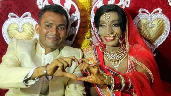 Mặt biến dạng vì axit, cô gái tìm thấy tình yêu nhờ cuộc gọi định mệnh - 2 Rahul vẫn nói lời cầu hôn dù đã tận mắt nhìn thấy khuôn mặt người yêu