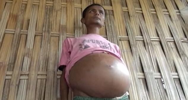 Chàng trai 21 tuổi vật vã với bụng tròn căng như bà bầu đến ngày sinh nở - 2 Anh bắt đầu cảm thấy đau bụng, khó thở từ 5 năm trước