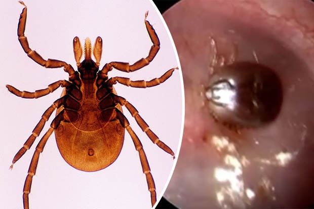 
Sinh vật 8 chân trốn trong tai người để hút máu.
