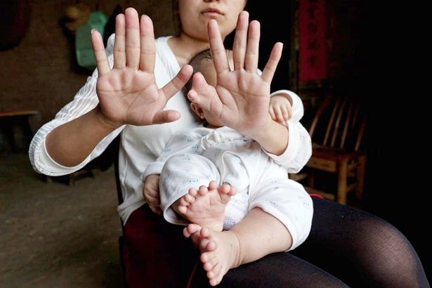 Những ca thừa bộ phận cơ thể kỳ quặc trên thế giới - 2 Mẹ cậu bé cũng có 12 ngón tay và 12 ngón chân