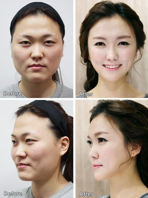 Bi hài 3 người phụ nữ bị giữ lại sân bay vì mặt phẫu thuật thẩm mỹ quá khác so với ảnh hộ chiếu - 2 Quảng cáo phẫu thuật thẩm mỹ ở Hàn Quốc