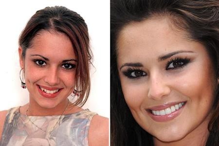 Loạt sao lớn “lột xác” nhờ sửa răng - 2 Hồi năm 2002, hàm răng của nữ ca sĩ Cheryl vẫn chưa được thẳng đều tăm tắp như bây giờ và theo tờ Daily Mail bật mí thì “họa mi nước Anh” đã chi tới 8.000 bảng Anh để sửa răng và mất thêm 1.500 bảng Anh tiền làm trắng răng hàng năm