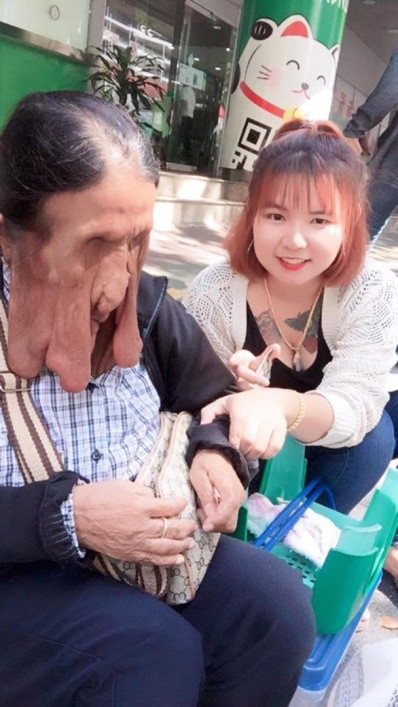 Căn bệnh lạ khiến cụ bà 63 chảy xệ mặt đến biến dạng - 2 Cô gái 22 tuổi Praew là người đã giúp cụ Wiang liên hệ với cơ quan y tế