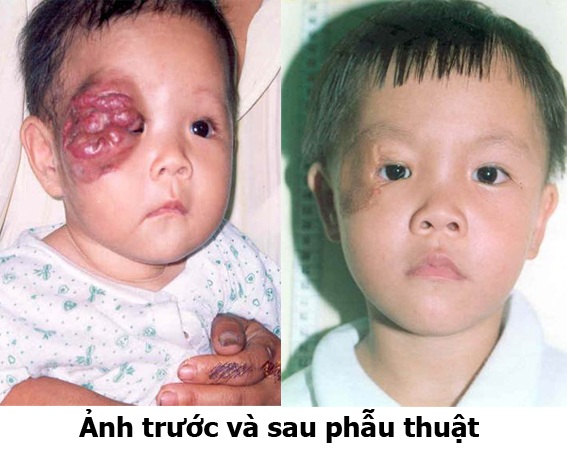 Bệnh u máu ở trẻ có chữa được không? - 3 Trường hợp 2: Bệnh nhân nam 15 tháng tuổi, bị u máu thể hang vùng mắt, đã được điều trị tiêm xơ và phẫu thuật tái tạo mắt.