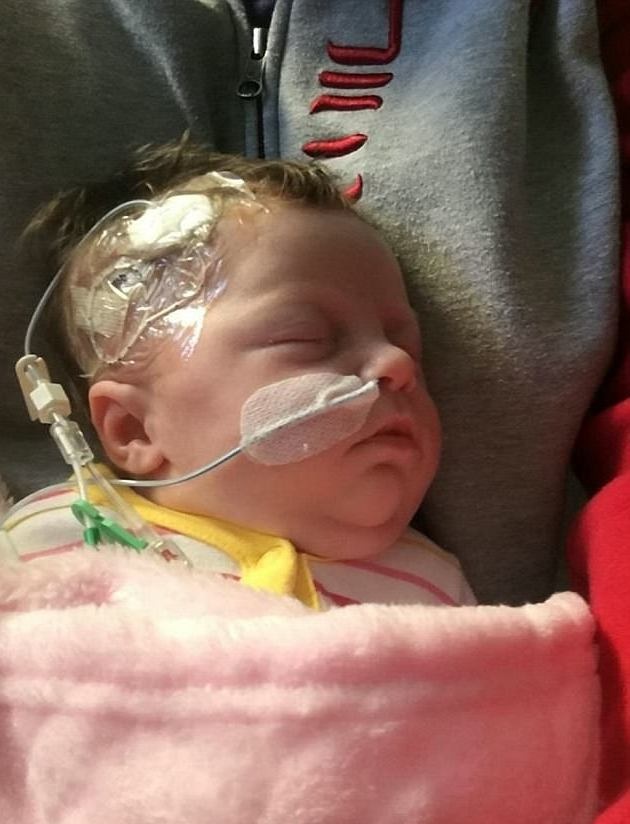 Bé sơ sinh quấn màng bọc thực phẩm vì "ruột để ngoài da" - 3 Ava-Rose bị cạo trọc một bên để bác sĩ truyền dinh dưỡng qua đường tĩnh mạch trên đầu