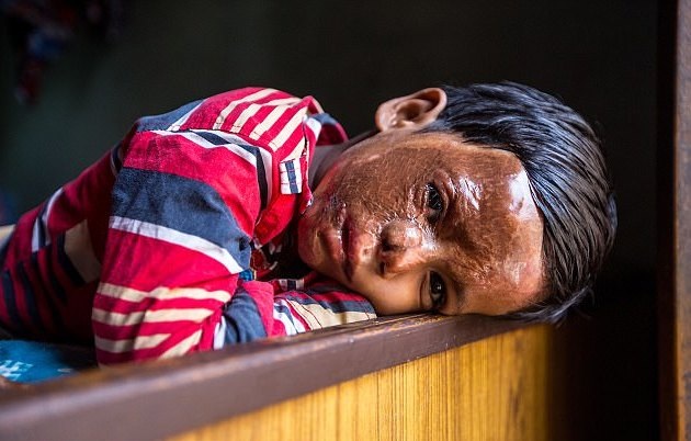 Không cưới được mẹ, trả thù man rợ bằng cách đổ axit lên mặt con - 3 Sau ba cuộc phẫu thuật, thị lực của Aditya đã phục hồi nhưng cậu bé sẽ phải mang khuôn mặt sẹo suốt đời