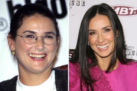 Loạt sao lớn “lột xác” nhờ sửa răng - 3 Răng miệng của Demi Moore cũng đã phải trải qua tu sửa để được trắng sáng như hiện tại