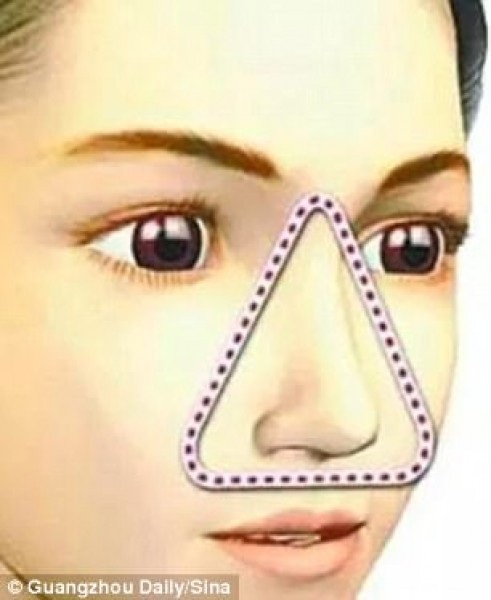 Bé gái bị áp xe não vì tự nặn mụn đầu đen - 4 Bé gái bị áp xe não vì tự nặn mụn đầu đen - 4