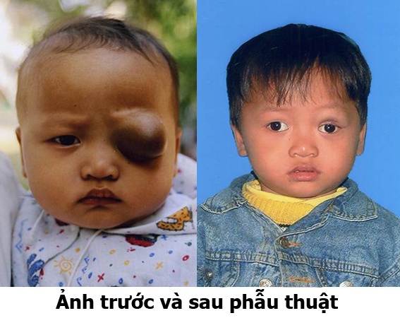 Bệnh u máu ở trẻ có chữa được không? - 4 Tuy nhiên, u máu là u lành tính nên có thể chữa khỏi hoàn toàn nếu được phát hiện sớm và các bậc cha mẹ không nên quá lo lắng nhé.