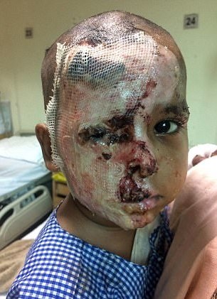 Không cưới được mẹ, trả thù man rợ bằng cách đổ axit lên mặt con - 4 Gương mặt thê thảm của Aditya sau khi bị tạt axit