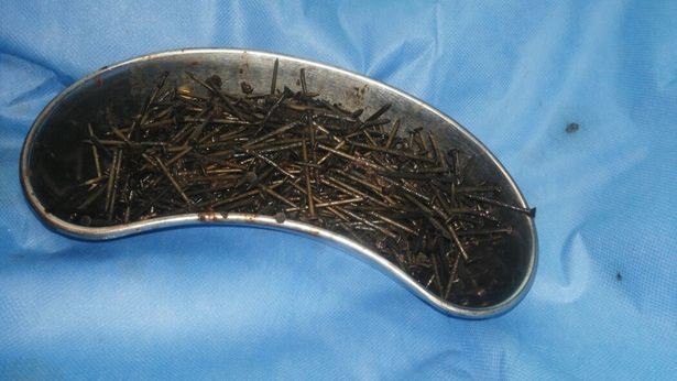 Dùng nam châm hút 600 đinh sắt ra khỏi bụng bệnh nhân - 3
Bác sĩ dùng nam châm trong quá trình phẫu thuật, hút đinh sắt ra khỏi bụng bệnh nhân.