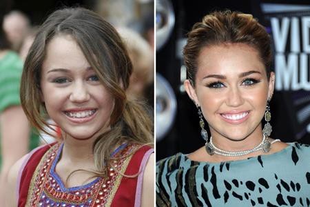Loạt sao lớn “lột xác” nhờ sửa răng - 5 Miley Cyrus từng phải nhổ bỏ tận 5 chiếc răng để có được khuôn miệng hoàn hảo như hiện tại