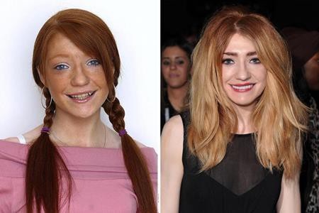 Loạt sao lớn “lột xác” nhờ sửa răng - 7 Nicola Roberts đã chi ra tới 13.000 bảng Anh để đầu tư cho một nụ cười tự tin hơn
