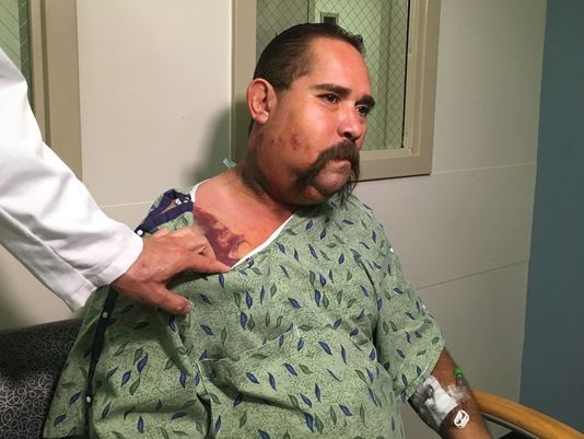 
Pratt bị cắn hai lần vào ngực và mặt
