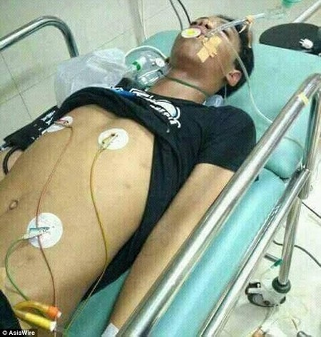 Bị rắn hổ mang cắn, thiếu niên chụp ảnh “khoe” lên mạng xã hội rồi tử vong - 2 Aril tử vong sau khi bị rắn cắn dù đã được tận tình cứu chữa