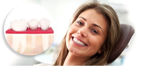 Dịch vụ cấy ghép Implant hoàn hảo - 1 Dịch vụ cấy ghép Implant hoàn hảo - 1