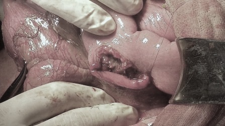 Nguy kịch vì bị cọc nhồi bê tông ép vỡ nội tạng - 1 Cọc bê tông ép khiến bệnh nhân bị vỡ, dập nhiều bộ phận nội tạng