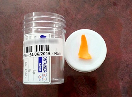 Người nhà “móc miệng” lấy đồ chơi khiến bé trai suýt tử vong - 1
Dị vật được nội soi lấy ra từ đường thở của bệnh nhi