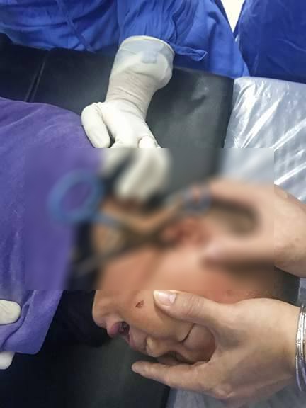 Hãi hùng cảnh bé trai 2 tuổi bị kéo đâm sâu vào tai - 1
Chiếc kéo đâm sâu vào tai bé. Ảnh BVCC