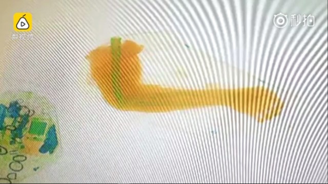 Hình ảnh cánh tay hiện lên trên màn hình máy soi