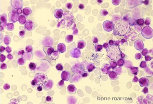Những điều cần biết về ghép tế bào gốc điều trị ung thư máu - 7