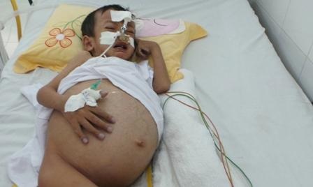 “Coi chừng” khi trẻ vàng da quá 15 ngày - 1 Bệnh nhi bị teo đường mật bẩm sinh, phẫu thuật Kasai trễ, điều trị tại bệnh viện Nhi Đồng 2