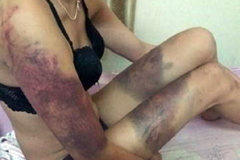 Hà Nội: Cơ quan Công an đang điều tra vụ cô gái bị người tình đánh thâm tím cơ thể - 1 Hình ảnh chị H tố bị bạn trai đánh, đập thâm tím cơ thể được đăng tải trên mạng xã hội facebook được lan truyền rộng rãi