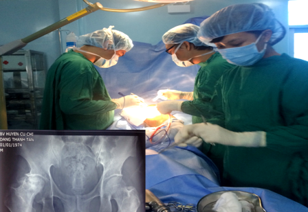 Chân ngắn, chân dài vì thoái hóa khớp háng - 1 Ca phẫu thuật thay khớp háng nhân tạo toàn phần đã được thực hiện thành công tại Bệnh viện huyện Củ Chi