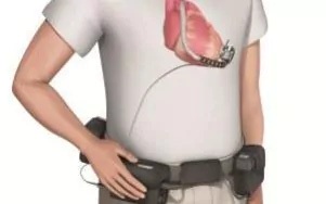 Bơm cơ học có thể đẩy lùi tổn thương tim - 2 Một thiết bị LVAD