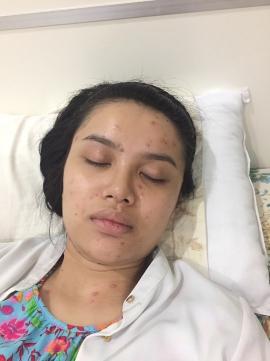 Diệu Thùy có nguy cơ bỏ thi Hoa hậu Đại Dương 2017 vì bệnh thủy đậu - 1 Hình ảnh gương mặt phát bệnh thủy đậu bất ngờ của thí sinh Nguyễn Thị Diệu Thùy (SBD 411).