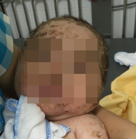 Tắm lá chữa thủy đậu, bé trai nhiễm độc, lở loét toàn thân - 1 Cháu bé 4 tháng tuổi bị nhiễm độc da toàn thân vì tắm lá chữa thủy đậu. Ảnh: BS cung cấp.