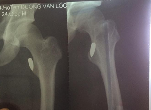 
Phim chụp X-quang cho thấy viên đạn nằm trong đùi nạn nhân chỉ cách xương vài milimet.
